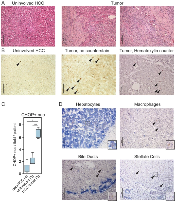 CHOP is expressed in human HCC tumors.
