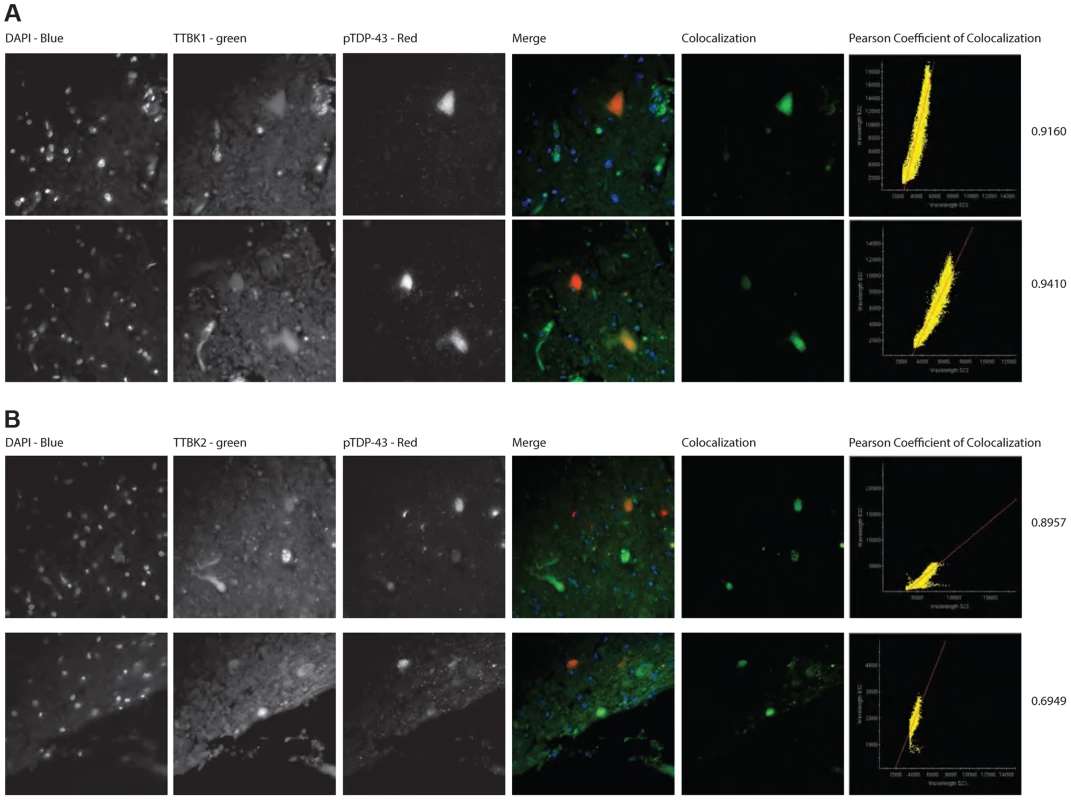 TTBK1/2 co-localize with phosphorylated TDP-43 in ALS spinal cord aggregates.