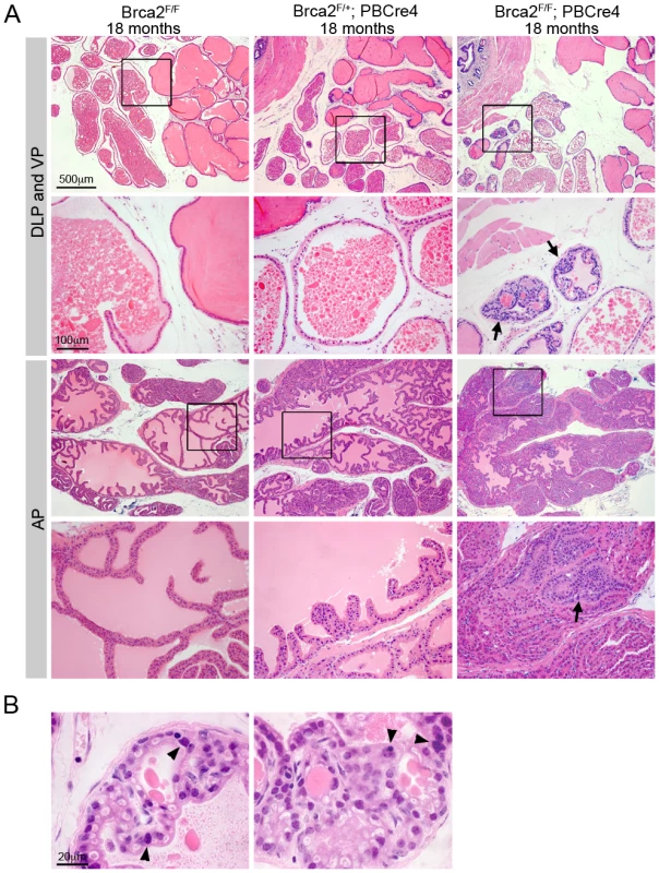 Deletion of <i>Brca2</i> from prostate epithelia results in hyperplasia and LG PIN.