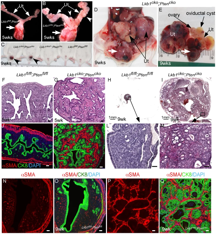 Formation of highly aggressive endometrial adenocarcinoma in <i>Lkb1<sup>cko</sup>;Pten<sup>cko</sup></i> mice.