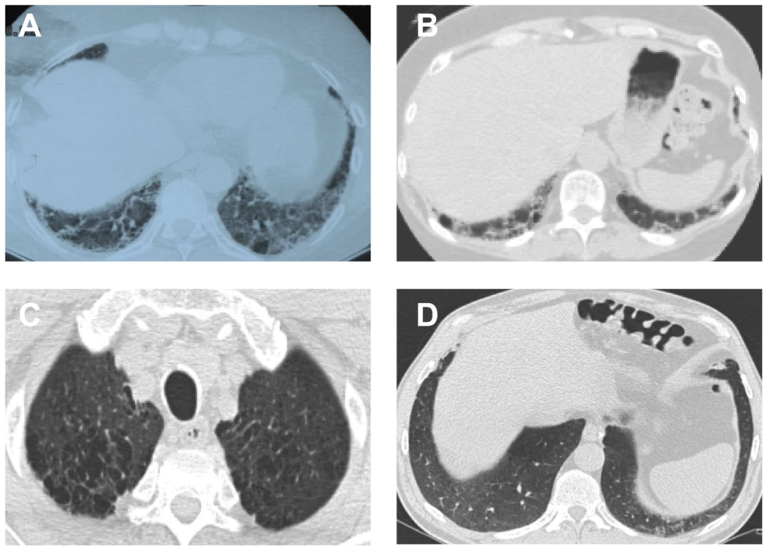 CAT scans from pulmonary fibrosis probands and non-carrier sibling with short telomeres.