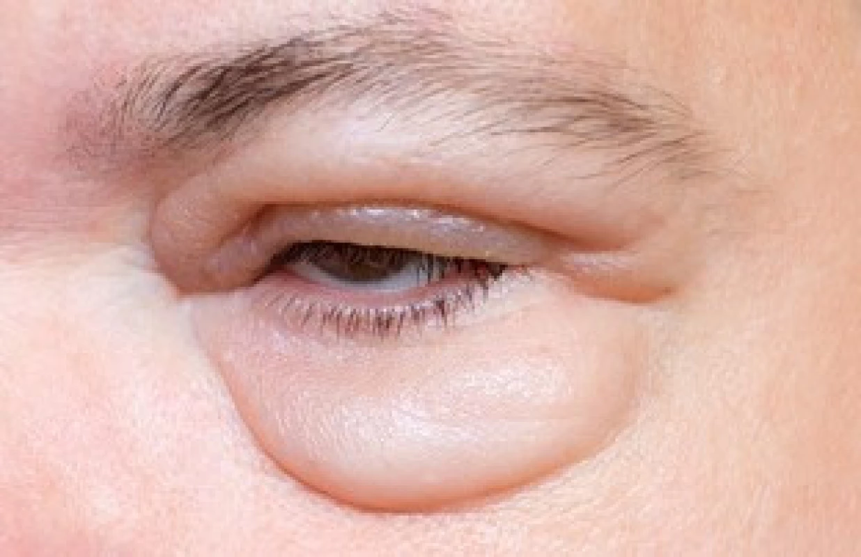 Prosáknutí kůže okolí oka