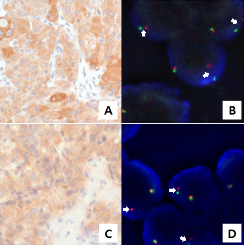 Anaplastic lymphoma kinase (ALK) staining using immunohistochemistry (IHC) and fluorescence <i>in situ</i> hybridization (FISH).