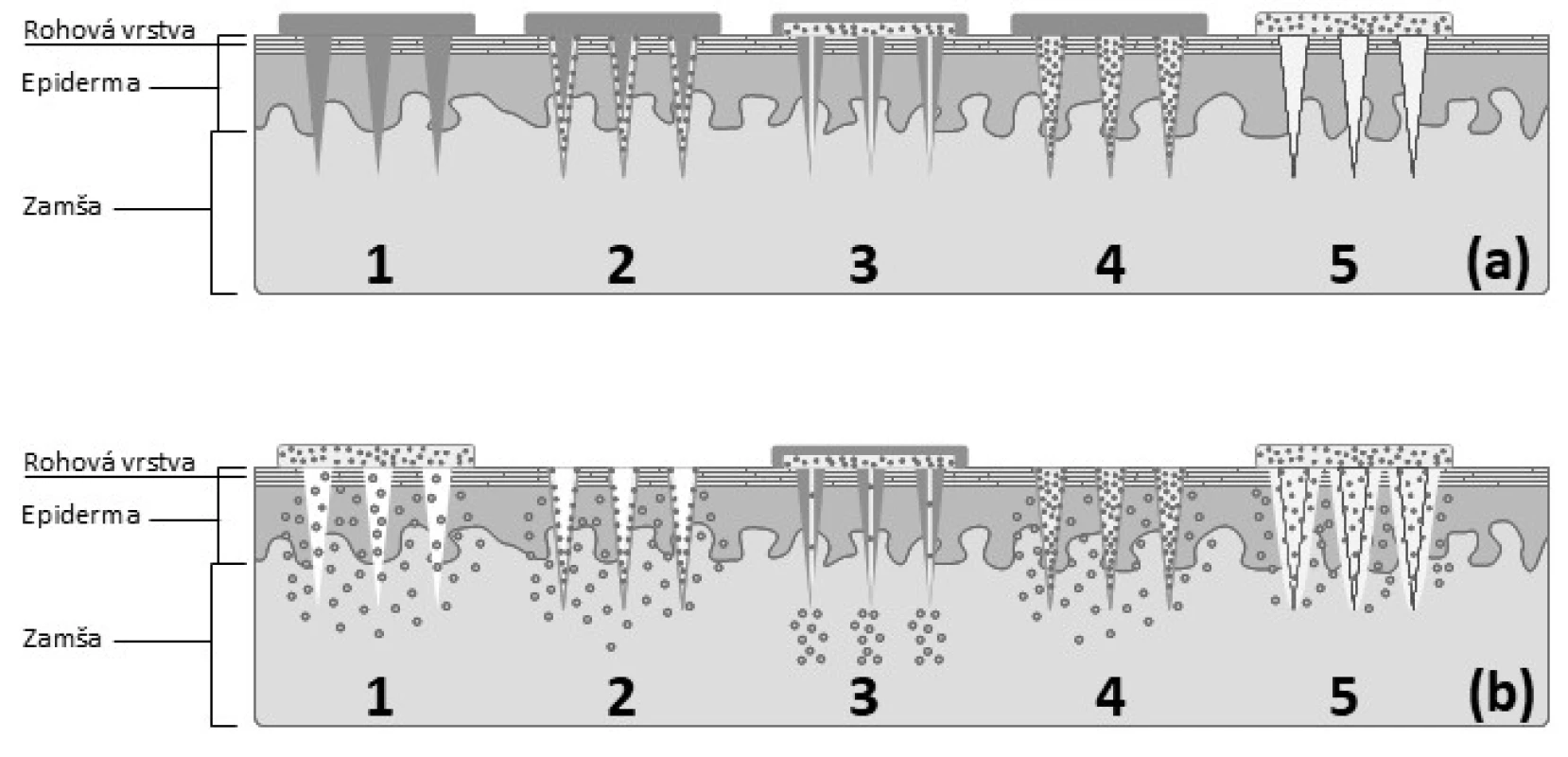 Schematické znázornenie jednotlivých typov zoskupení MI a mechanizmu prieniku
liečiva do zamše: aplikácia jednotlivých typov MI (a), permeácia liečiva cez prepichnutú
pokožku(b)
1 – pevné MI, 2 – vrstvené MI, 3 – duté MI, 4 – matricová MI, 5 – hydrogélové MI
(spracované podľa<sup>41)</sup>)